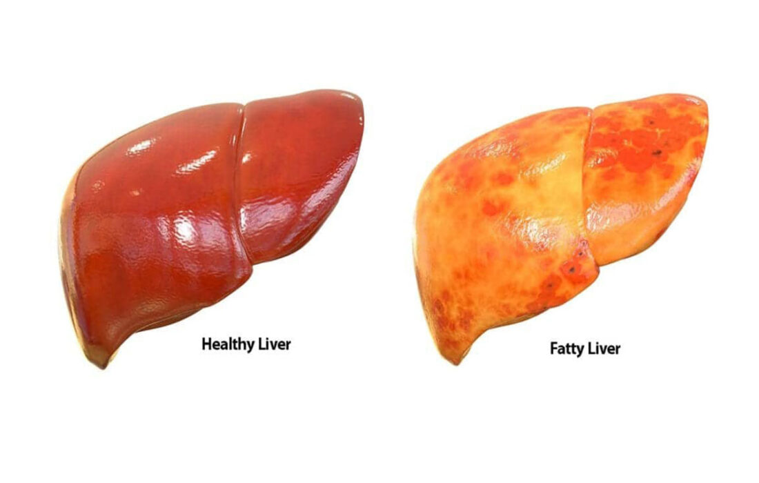 15 روش درمان کبد چرب