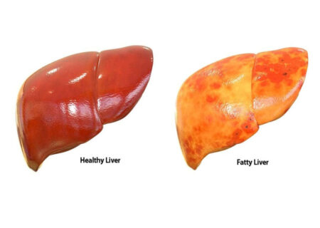 15 روش درمان کبد چرب