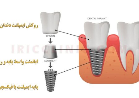 قیمت ایمپلنت دندان 1402 تهران