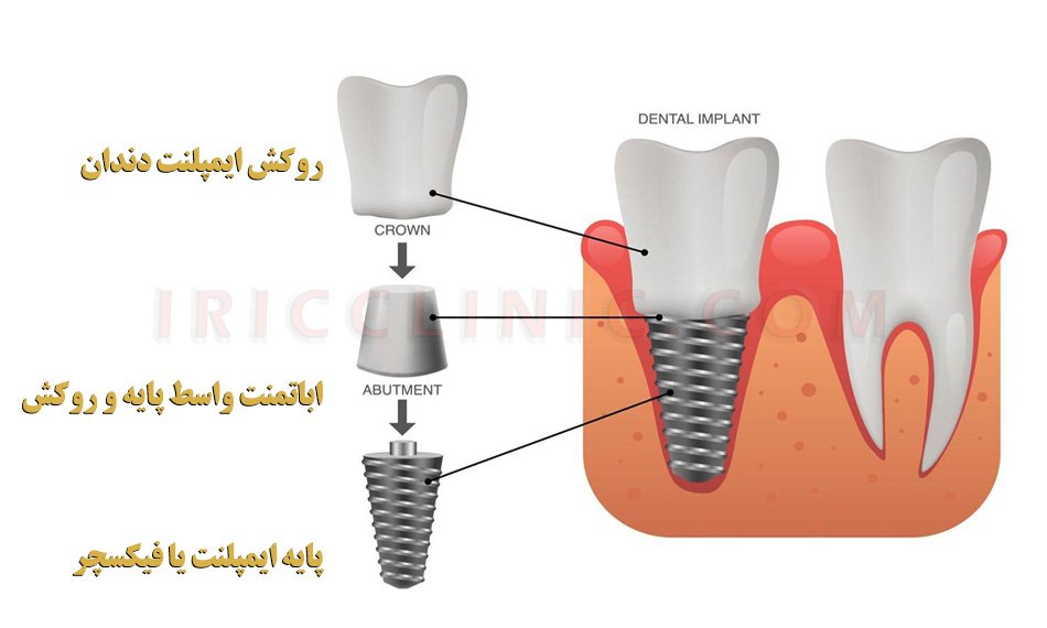 قیمت ایمپلنت دندان 1402 تهران