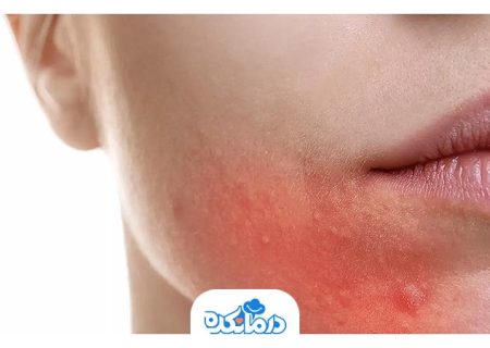 درماتیت اطراف دهان یا Perioral Dermatitis چیست؟