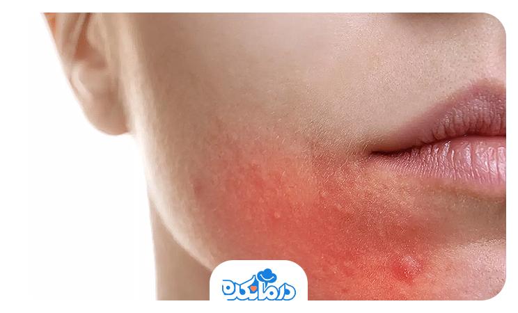 درماتیت اطراف دهان یا Perioral Dermatitis چیست؟