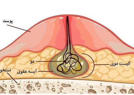 آیا باید کیست مویی را درمان کنیم؟