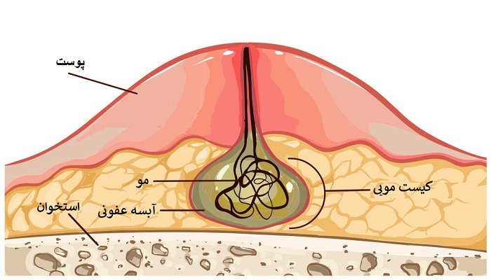 آیا باید کیست مویی را درمان کنیم؟