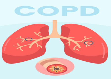 COPD چیست؛ علت، علائم، روش تشخیص و درمان