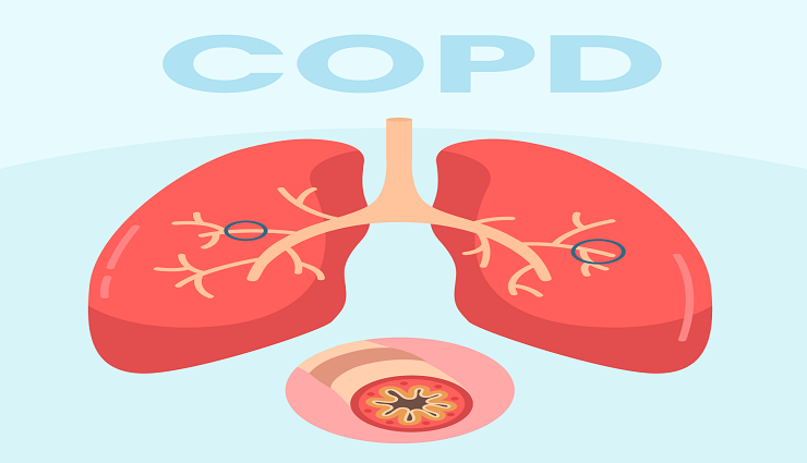 COPD چیست؛ علت، علائم، روش تشخیص و درمان