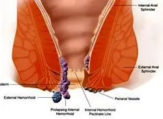 درمان هموروئید با این روش ساده بواسیر را درمان کنید