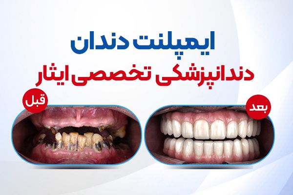 ایمپلنت، ارتودنسی و کامپوزیت دندان.