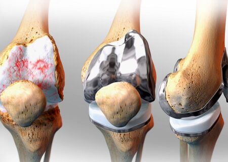 جراحی تعویض مفصل زانو؛  همه ی چیزهایی که لازم است بدانی