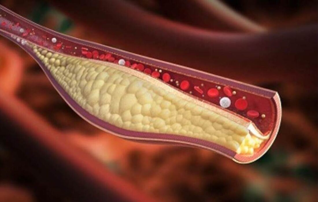 4 راه حل مفید و غیر دارویی برای کاهش سریع کلسترول بد خون