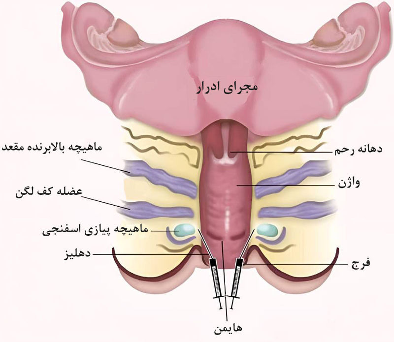 درمان واژینیسموس