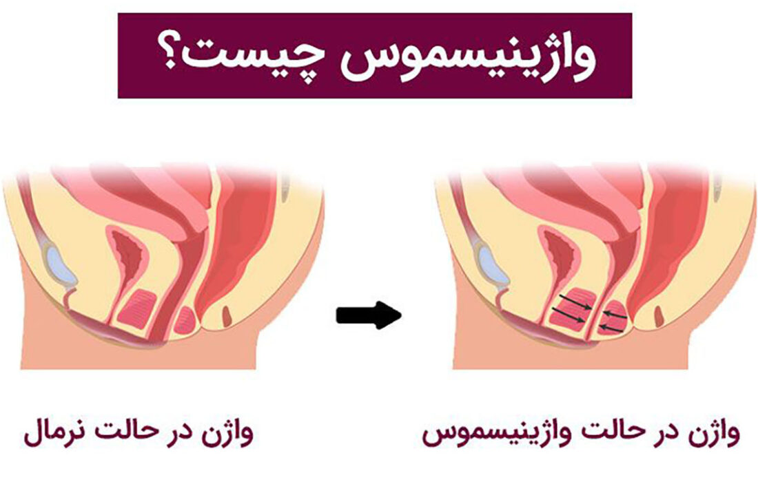 واژینیسموس چیست؟ / جدول درمان واژینیسموس و مزایا و معایب