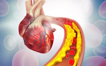 بدترین غذاها برای افزایش کلسترول خون – رادناک