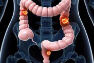 بهترین داروی گیاهی برای پیشگیری از سرطان روده بزرگ