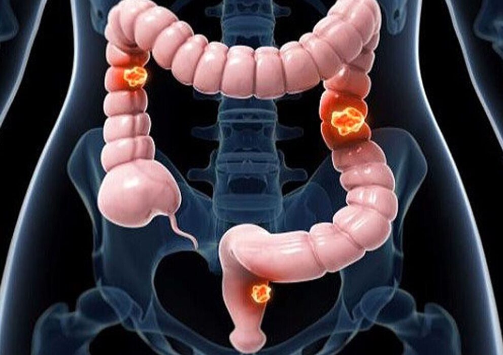 بهترین داروی گیاهی برای پیشگیری از سرطان روده بزرگ