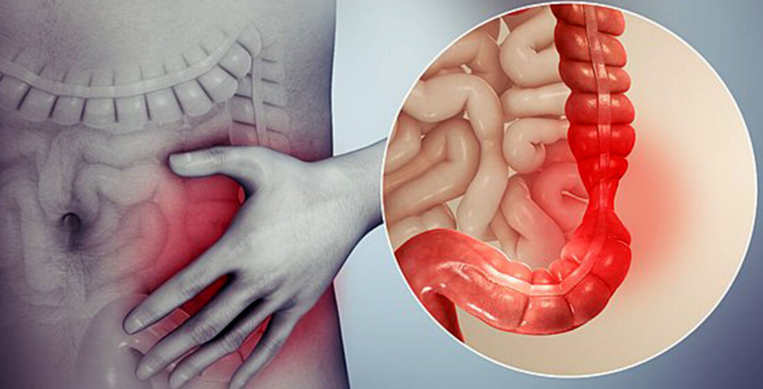 سندرم روده تحریک پذیر چیست؟